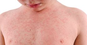 Measles Warning for Sydney Airport and CBD After Infectious Case
