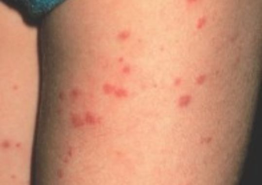 Meningococcal disease cases in the South
