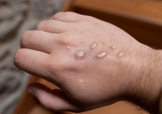 Mpox course to support GPs to ‘stay informed and proactive’