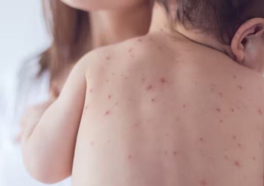 Measles Warning Issued for Sydney Area