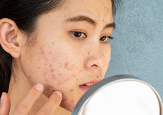 Bid to overturn isotretinoin prescribing restrictions