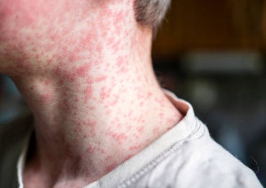 Measles alert for Sydney 29 Aug