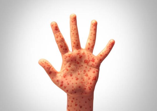 Measles alert for Sydney Airport and Northern NSW