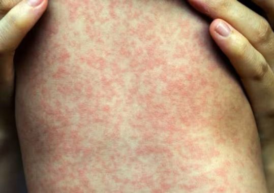 New measles cases prompt Sydney health warning