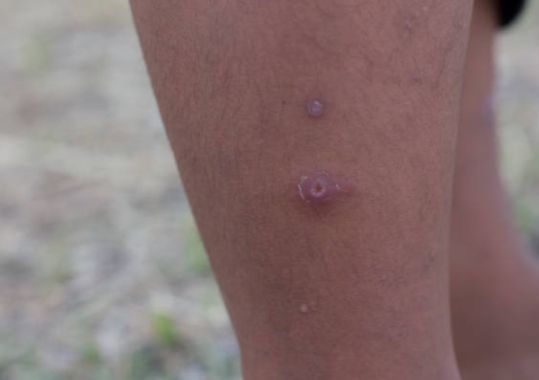 Meningococcal Case in Adelaide Hospitalised