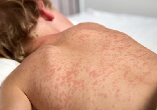 Measles Alert Issued for Sydney and Northern Sydney