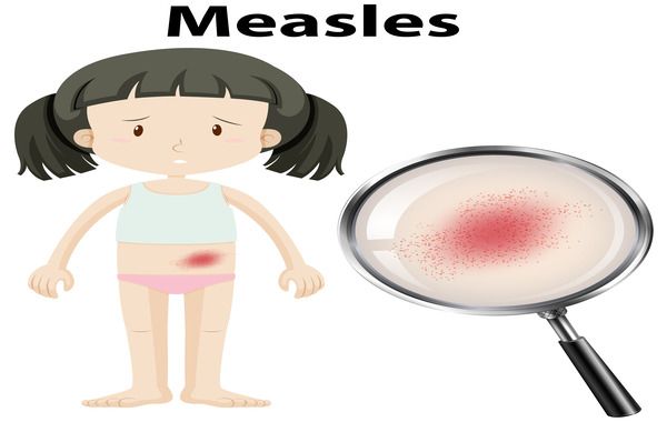 Measles alert for western Sydney March