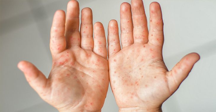 Measles alert for Western Sydney 31 March