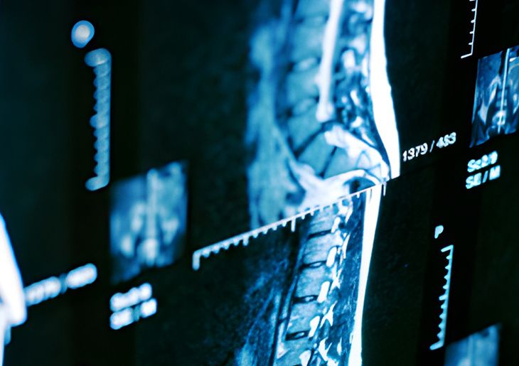 Four Corners story on spinal surgery and billing