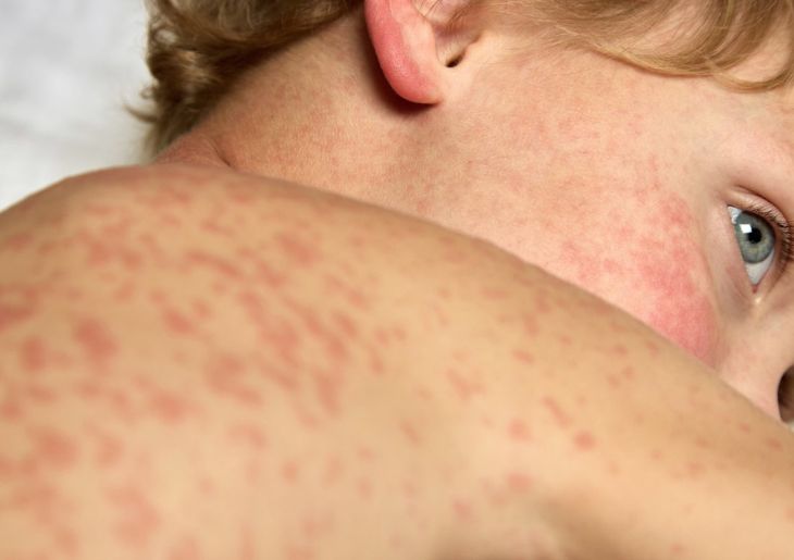 Measles case 2025