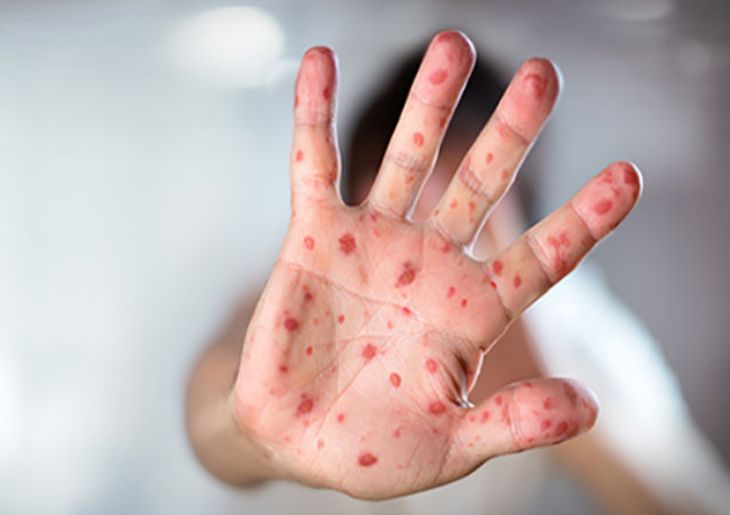 Important Measles Notification for Sydney Residents