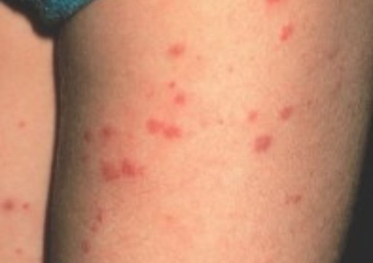Meningococcal disease cases in the South