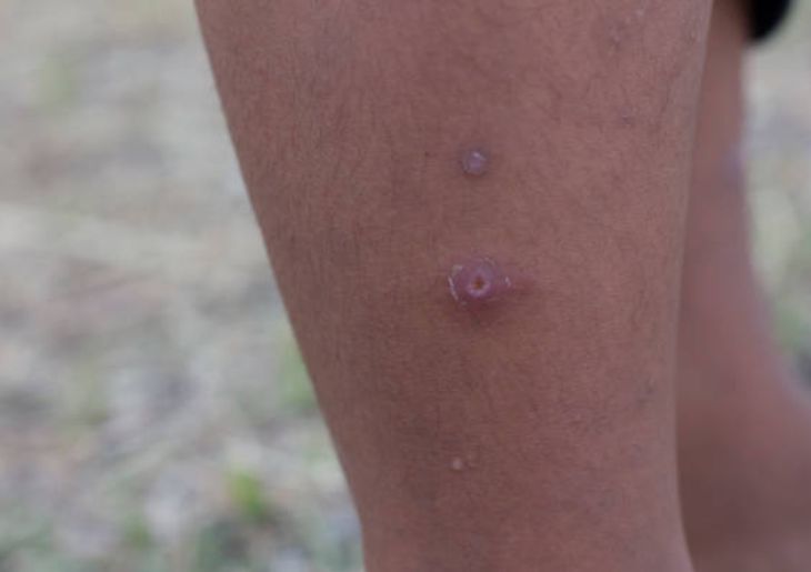 Meningococcal Case in Adelaide Hospitalised